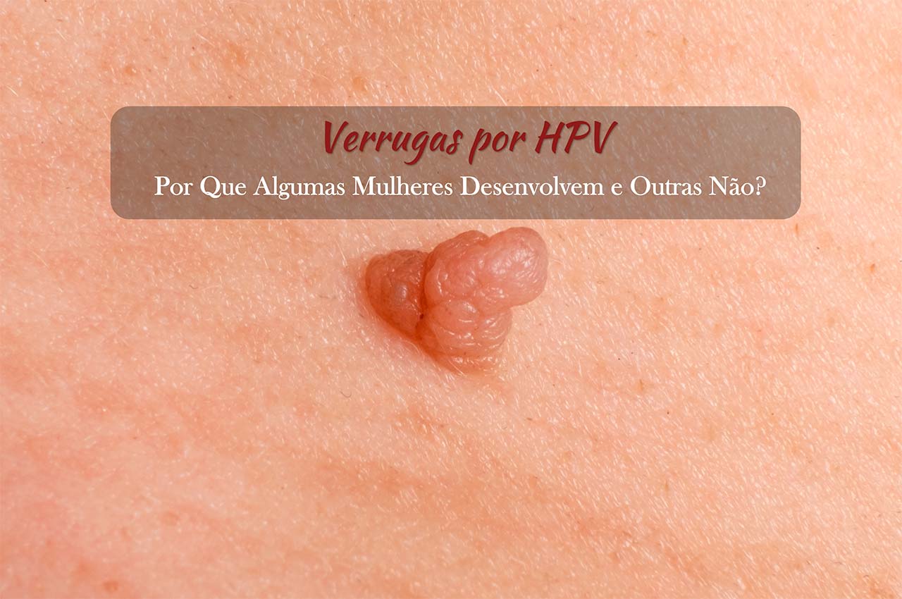 Por Que Algumas Mulheres Desenvolvem Verrugas por HPV e Outras N&atilde;o?