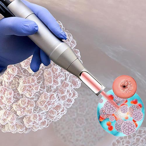 Tratamento a Laser para Lesões HPV - Ginecologista em Vitória - Espírito Santo, colposcopia e laser ginecológico.