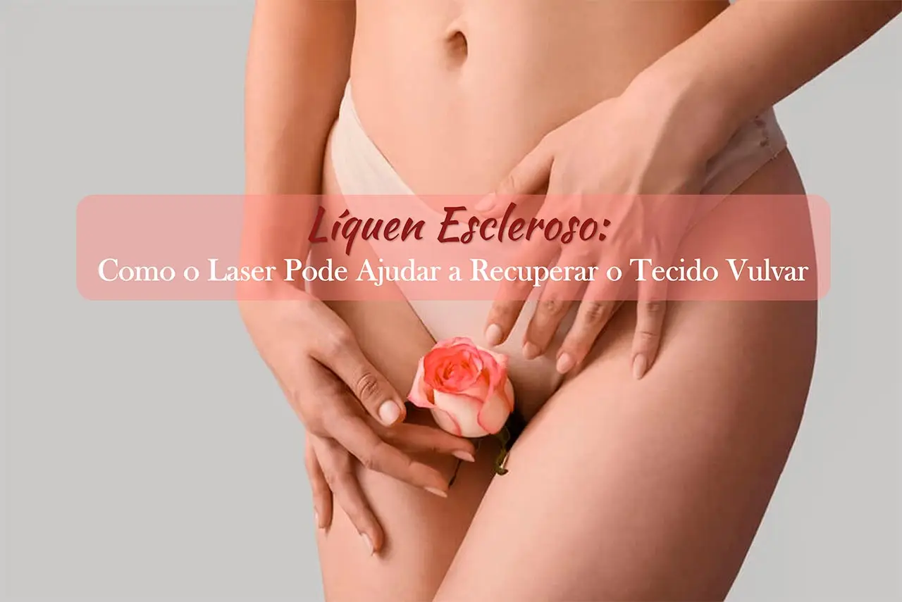 Líquen Escleroso: Como o Laser Pode Ajudar a Recuperar o Tecido Vulvar
